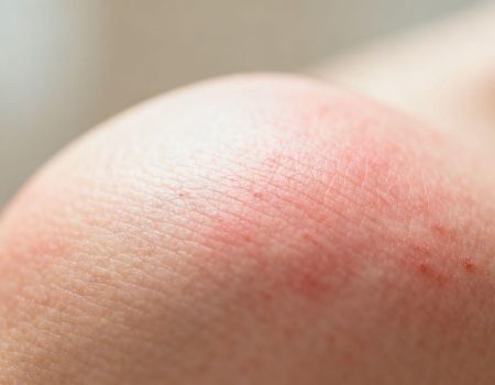 Skin with mild redness and irritation.
